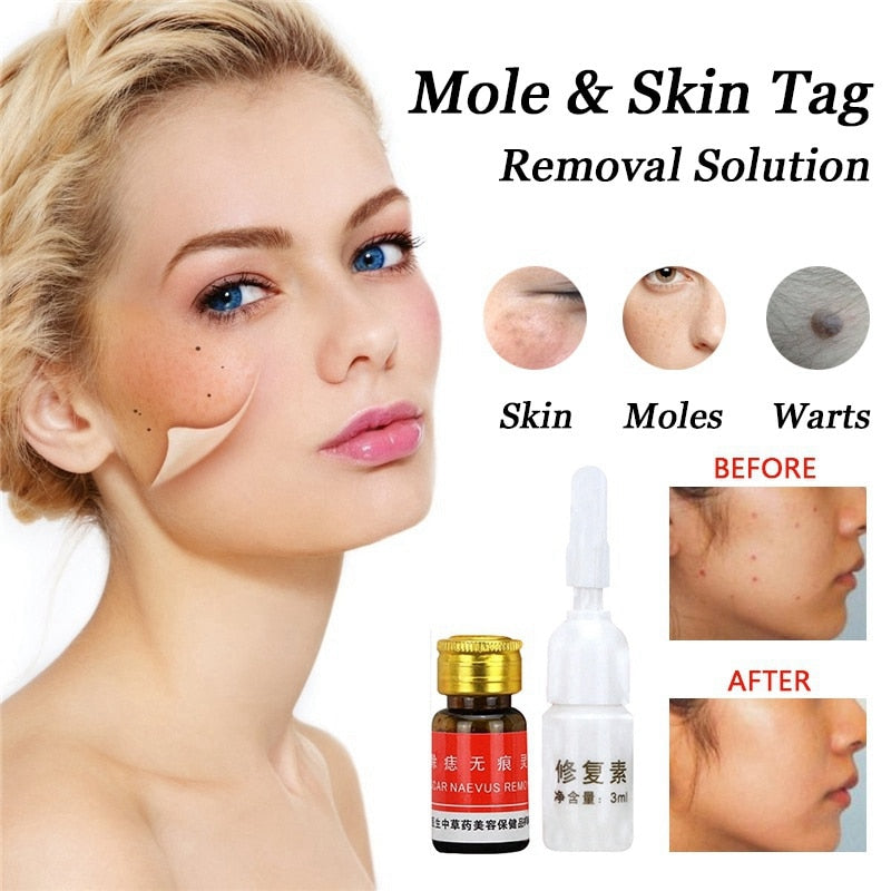 Mole Removal Solution Painless Mole Skin Dark Spot Removal Face Wart Tag Freckle Removal Cream Oil Blemish Removers