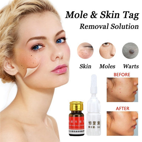 Mole Removal Solution Painless Mole Skin Dark Spot Removal Face Wart Tag Freckle Removal Cream Oil Blemish Removers